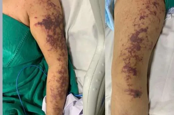 Việt Nam: Bệnh liên cầu lợn bùng phát ở Huế, mối nguy từ thói quen ăn tiết canh 