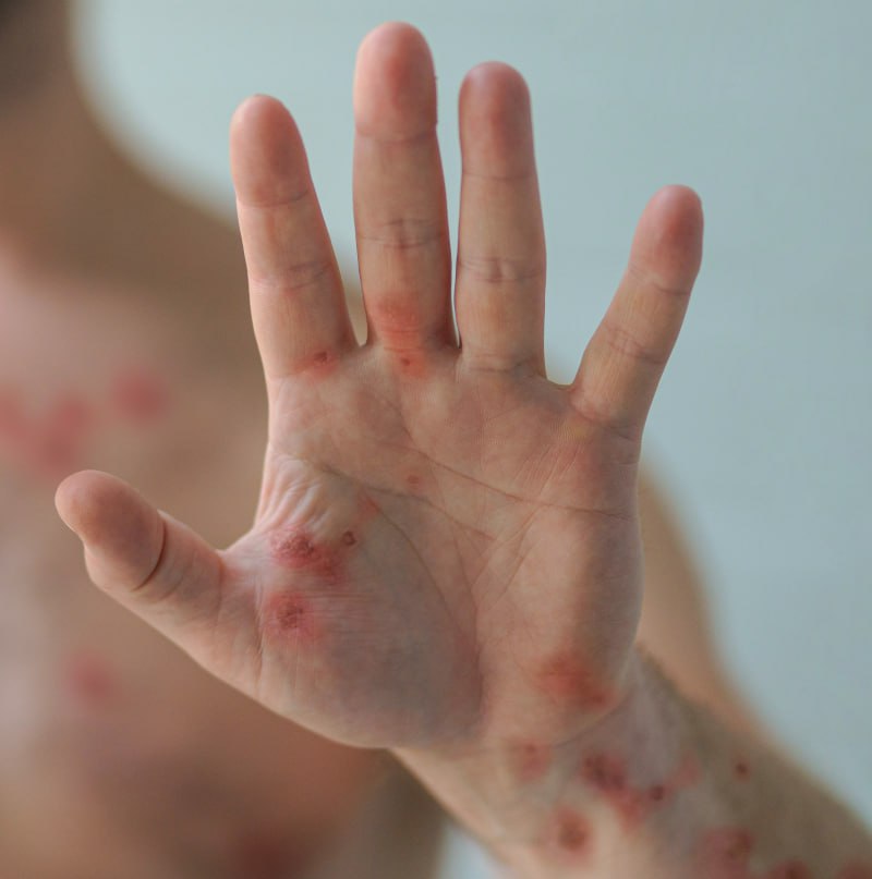 WHO: Cảnh báo tình trạng khẩn cấp toàn cầu với bệnh nhiễm trùng do virus đậu mùa khỉ WHO: Cảnh báo tình trạng khẩn cấp toàn cầu với bệnh nhiễm trùng do virus đậu mùa khỉ