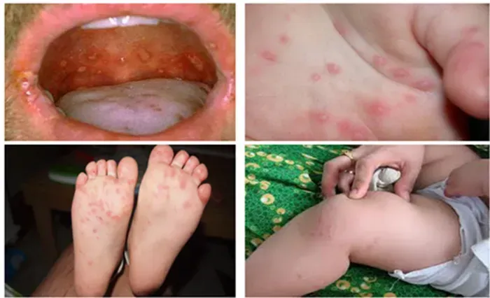 Bộ Y tế cảnh b&aacute;o dịch tay ch&acirc;n miệng nguy hiểm g&acirc;y tử vong ở trẻ em