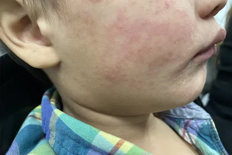 CDC: Ca mắc sởi tại Hoa Kỳ vượt 2.300, cao nhất trong 35 năm qua