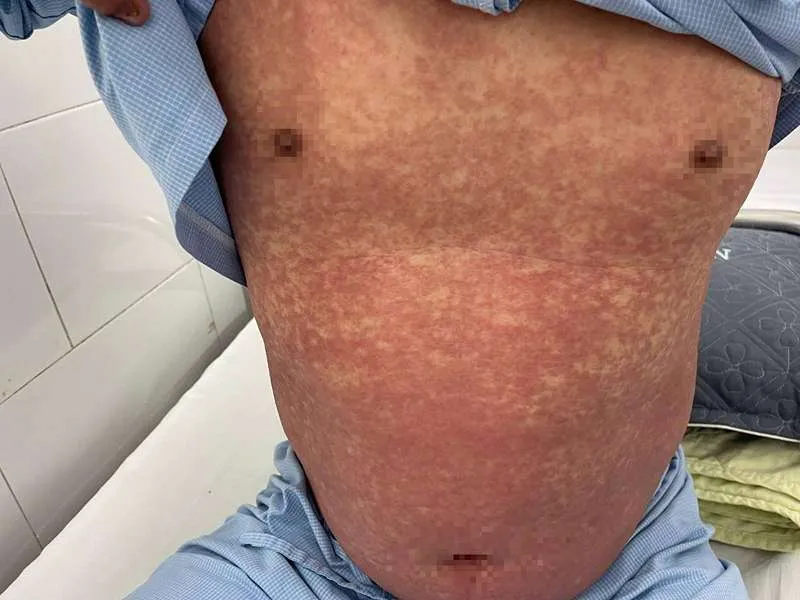 Cảnh báo Phenylbutazone bị cấm vẫn được rao bán trên mạng xã hội