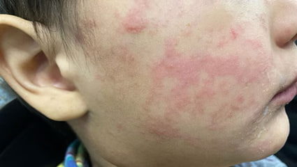 Việt Nam: Tăng cường các biện pháp phòng, chống và kiểm soát dịch bệnh sởi Việt Nam: Tăng cường các biện pháp phòng, chống và kiểm soát dịch bệnh sởi
