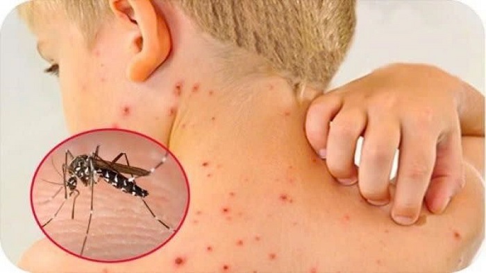 Một số bệnh có nguy cơ bùng phát trong mùa mưa bão Một số bệnh có nguy cơ bùng phát trong mùa mưa bão