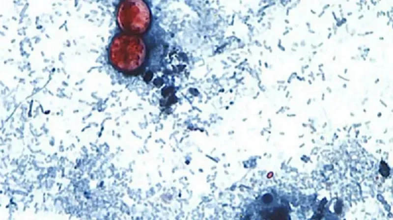 Michigan: Số ca mắc bệnh Cyclosporiasis vượt 2.600 ca, nghi liên quan rau salad