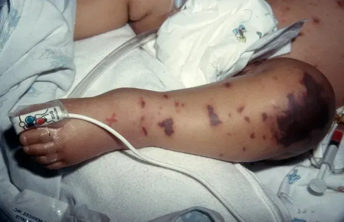 Cảnh b&aacute;o: Kh&oacute;i thuốc l&aacute; l&agrave;m tăng nguy cơ mắc n&atilde;o m&ocirc; cầu ở trẻ em